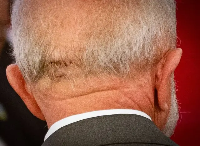 Presidente Lula tem hemorragia e faz cirurgia de emergência