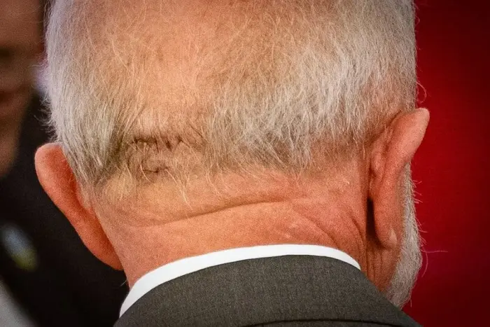 Presidente Lula tem hemorragia e faz cirurgia de emergência