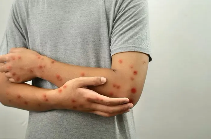 Nova cepa do Mpox é identificada no Brasil - Foto:  Getty Images
