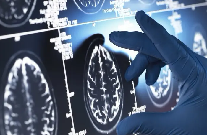 Medicamento inédito para Alzheimer em estágio inicial é aprovado pela Anvisa - Foto: Getty Images