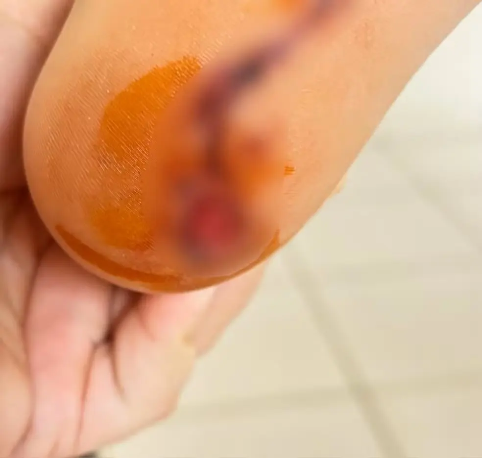 Menino ficou ferido após ataque de piranha — Foto: Arquivo Pessoal Menino ficou ferido após ataque de piranha — Foto: Arquivo Pessoal