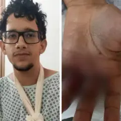 Situação que ficou a mão de Thiago Sousa Santos Cruvinel, de 20 anos — Foto: Arquivo Pessoal/Sirley Sousa