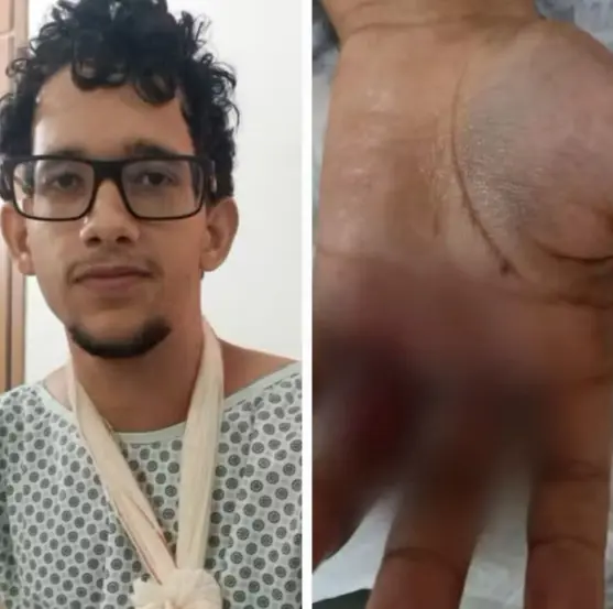 Situação que ficou a mão de Thiago Sousa Santos Cruvinel, de 20 anos — Foto: Arquivo Pessoal/Sirley Sousa
