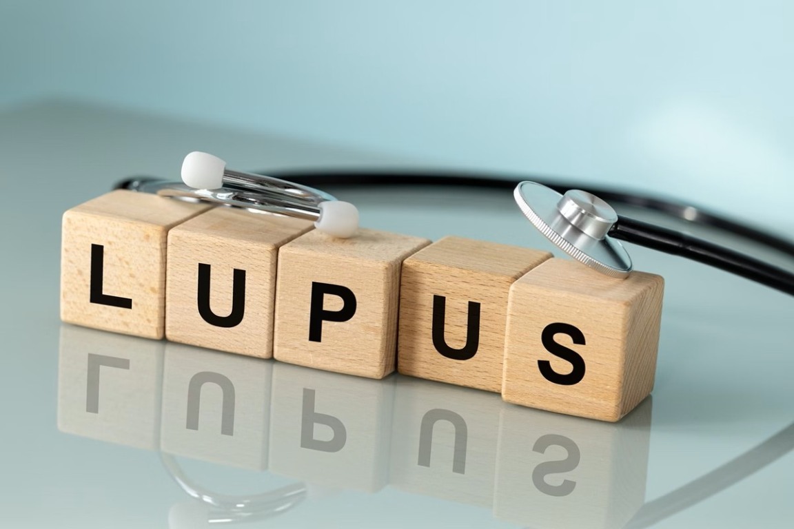 Lúpus - Foto: Getty Images