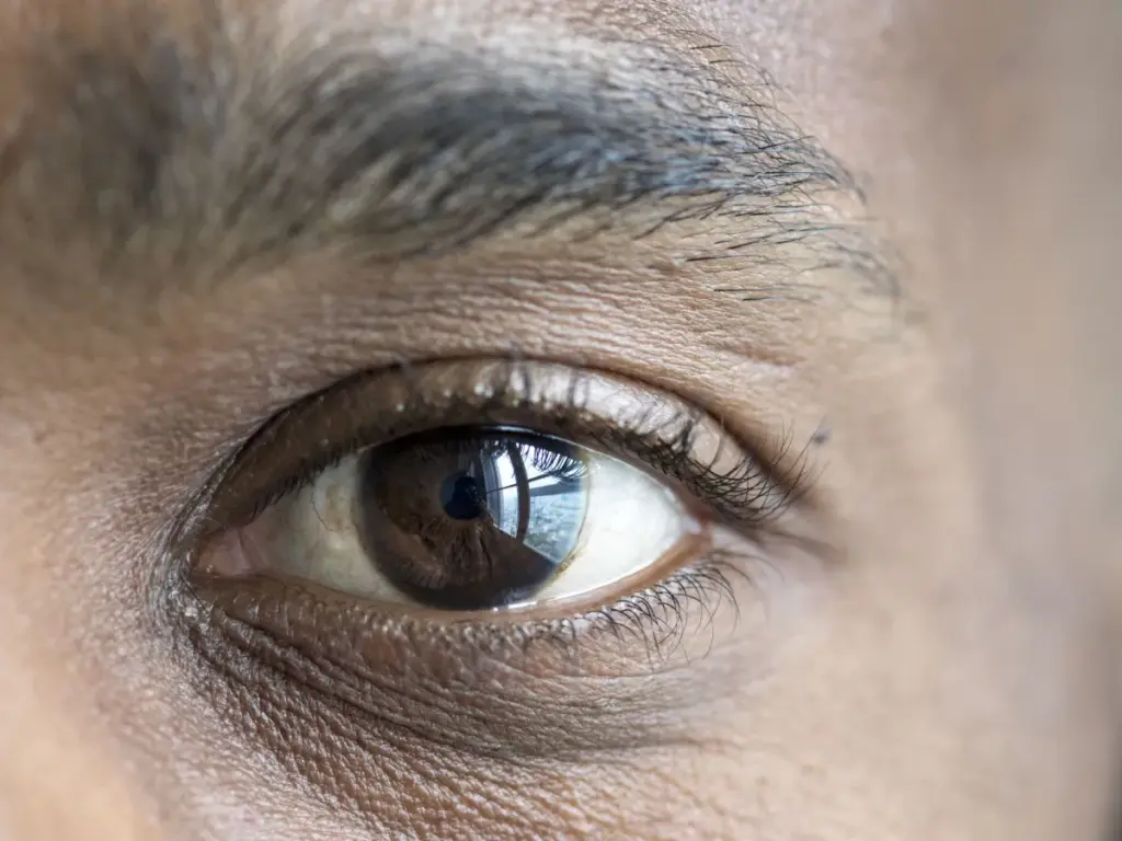 Entenda como o metanol destrói o nervo óptico e pode causar cegueira Entenda como o metanol destrói o nervo óptico e pode causar cegueira