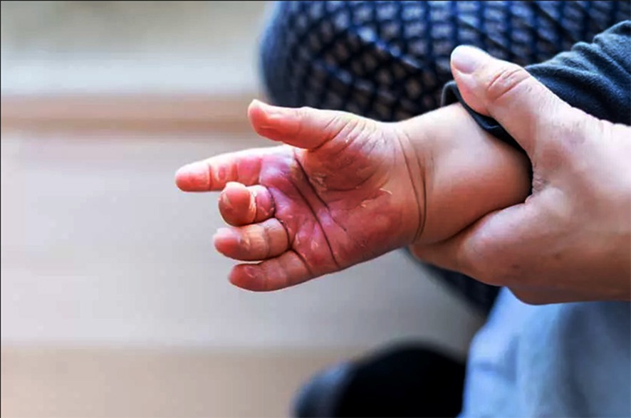 Férias e calor acendem alerta no Tocantins: 44 crianças pequenas foram internadas por queimaduras só este ano Férias e calor acendem alerta no Tocantins: 44 crianças pequenas foram internadas por queimaduras só este ano