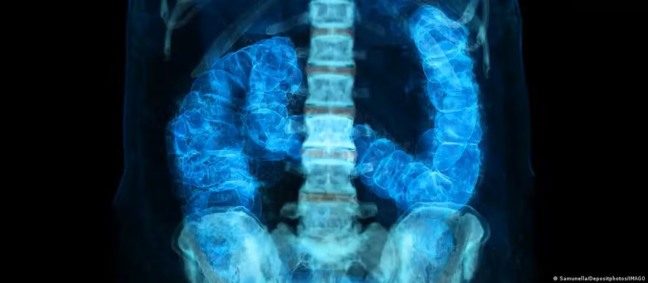 Câncer no intestino avança entre americanos menores de 50 anos — Foto: Samunella/Depositphotos/IMAGO